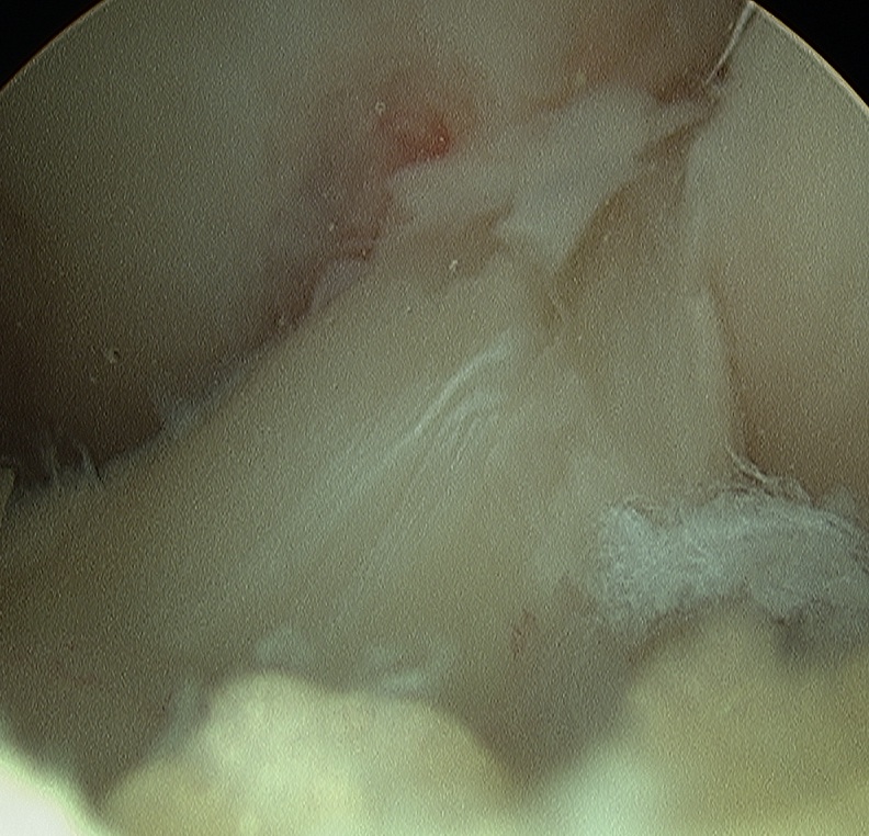 Arthroscopy Lax ACL